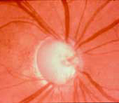 Primary Open Angle Glaucoma / Juvenile Open Angle Glaucoma